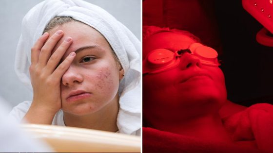 Can at-home red-light therapy really cure acne?