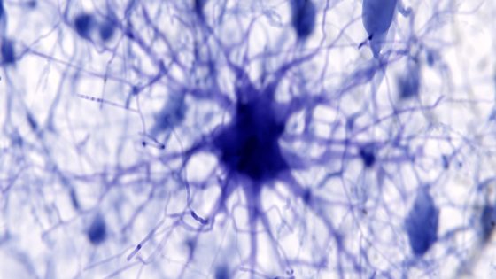 AI Discovers Suspected Trigger of Alzheimer's, And Maybe a Treatment : ScienceAlert
