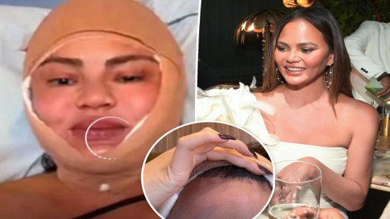 Chrissy Teigen gets hairline lowered in shocking procedure