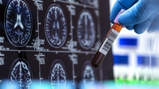 First FDA-cleared Alzheimer’s blood test set to boost diagnoses' speed, accuracy : Shots