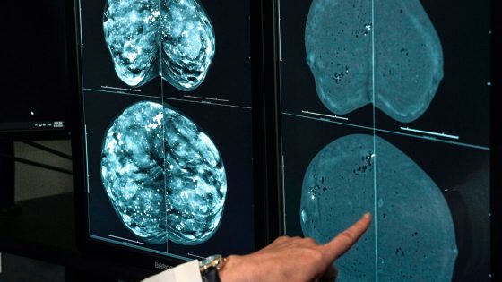 One Type of Mammogram Proves Better for Women With Dense Breasts