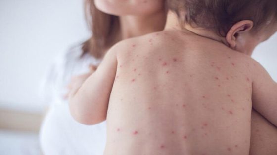 Measles Case Confirmed in Williamsburg