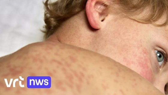 Mazelenbesmettingen blijven stijgen, vooral in Antwerpen en Limburg