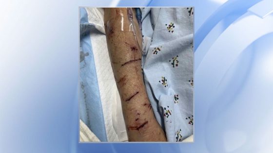 Rabid fox bites Raleigh woman, marking third bite incident this month :: WRAL.com