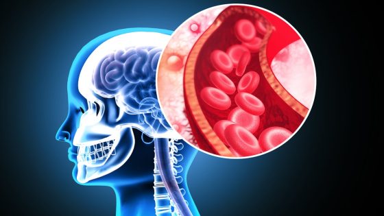 Stanford develops milli-spinner device for more effective stroke treatment